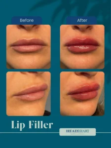 Before and after close-up images of lips showing enhanced volume and gloss from lip filler treatment.