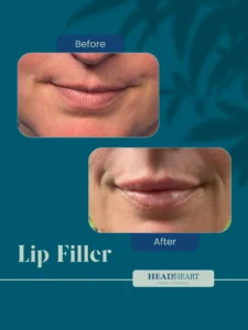 Before and after close-up images of lips showing fuller appearance post lip filler treatment.