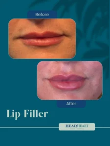 Before and after close-up images of lips showing fuller volume post lip filler treatment.