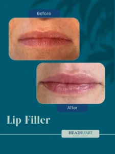 Before and after close-up images of lips showing results of lip filler treatment.