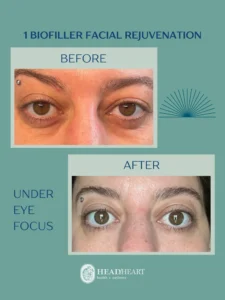 Before and after close-up images of under-eye area showing results of biofiller facial rejuvenation.