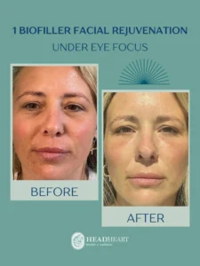 Before and after images of a woman's face showing results of under-eye biofiller facial rejuvenation.