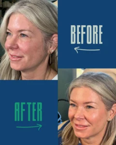 Before and after close-up portraits of a middle-aged woman with blonde hair, showing improved skin texture and complexion.