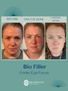 Before and after photos of a woman showing under-eye bio filler treatment results.