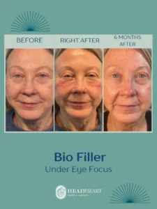 Before, immediately after, and six months post bio filler treatment under the eyes on a mature woman.