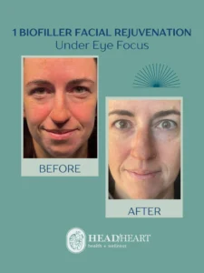 Before and after photos of a woman showing under eye improvement after biofiller facial rejuvenation.
