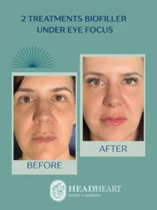 Before and after photos of a woman’s face showing under-eye biofiller treatment results.
