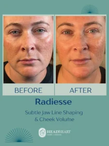 Before and after comparison of a woman's face showing subtle jawline shaping and cheek volume enhancement.