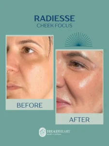 Before and after close-up images of a woman's cheek showing improved skin smoothness and volume.