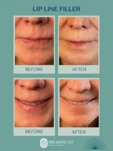 Before and after close-up images of lip line filler treatment on a woman's mouth.