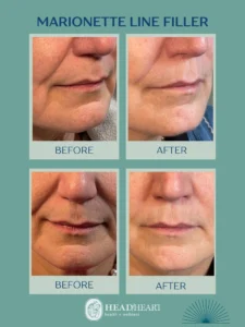 Before and after close-up images of marionette line fillers on lower face and chin areas.
