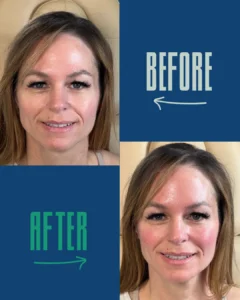 Before and after close-up photos of a woman’s face with noticeable skin tone changes.