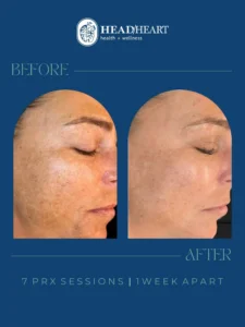 Before and after close-up images of a woman's face showing improved skin texture and reduced pigmentation after seven PRX sessions, one week apart.