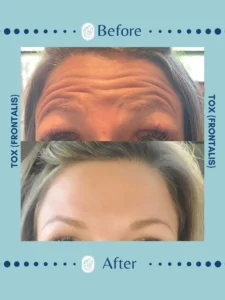 Before and after comparison of a woman's forehead showing significant reduction of wrinkles following Botox treatment.