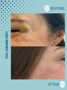Before and after close-up images of a woman's eye area showing reduced crow's feet wrinkles.