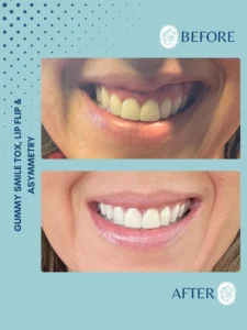 Before and after close-up images of a woman's smile showing dental and lip symmetry improvements.