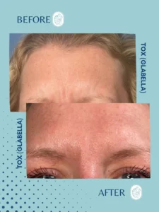 Close-up comparison of a woman's forehead before and after Botox treatment, showing reduced wrinkles.