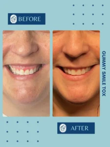 Before and after close-up images of a smile showing reduced gum exposure labeled "Gummy Smile Tox.