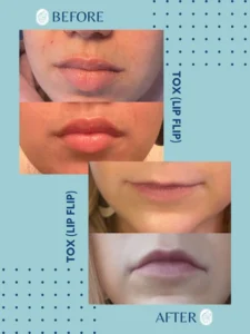 Before and after close-up images of lip flip cosmetic treatment results on two individuals.