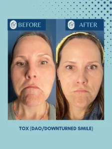 Before and after comparison of a woman with a downturned smile, showing facial improvement.