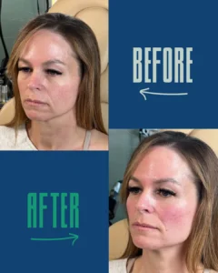 Before and after comparison of a woman’s facial skin showing increased redness in the after image.