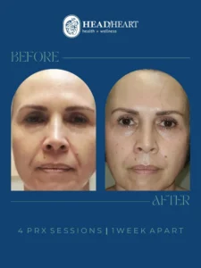 Before and after close-up images of a woman's face showing skin improvement after four PRX sessions, one week apart.
