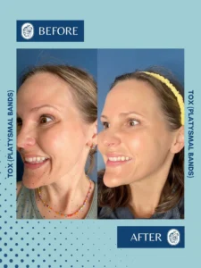 Before and after side profile images of a woman showing results of TOX treatment for platysmal bands.