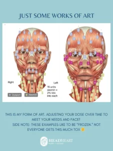 Diagram of facial muscles with injection points and dosage units for Dysport and Xeomin treatments.