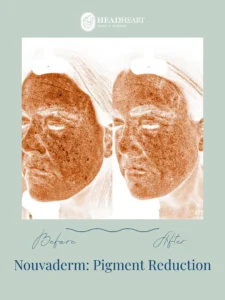 Before and after facial pigment reduction images with visible skin improvements, branded by Head/Heart health + wellness.