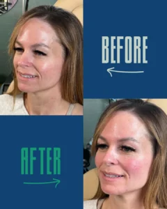 Before and after close-up images of a woman’s face showing subtle skin and complexion changes.