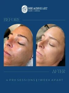 Before and after close-up images of a woman's face showing skin improvement after four PRX sessions, one week apart.