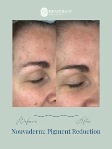 Close-up before and after images of a woman’s cheek showing reduced pigmentation and improved skin tone.