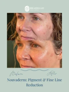 Before and after close-up images of a woman's face showing pigment and fine line reduction treatment results.