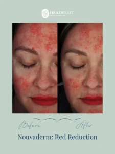 Before and after close-up images of a woman's face showing reduced facial redness.