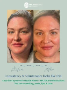 Before and after comparison of a woman's facial skin showing reduced redness and smoother texture.