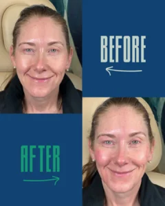 Before and after images of a woman with light skin and light brown hair, showing facial changes, labeled with "BEFORE" and "AFTER" text on a blue background.