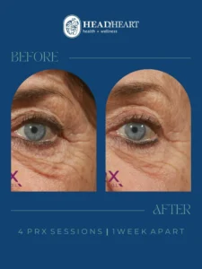 Close-up before and after images of a blue eye showing reduced wrinkles around the eye.