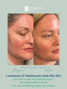 Before and after close-up images of a woman's face showing significant skin improvement.