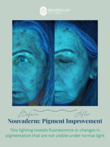 Before and after ultraviolet images of facial skin showing pigment improvement under specialized lighting.