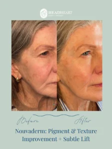 Before and after side profile images of an older woman showing skin pigment and texture improvement with subtle lift, accompanied by Head/Heart health and wellness branding.
