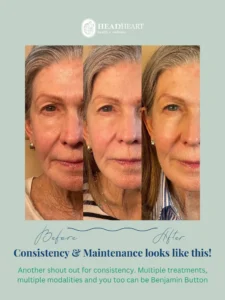 Before and after images of an older woman showing facial skin improvement from treatments, with text about consistency and maintenance.
