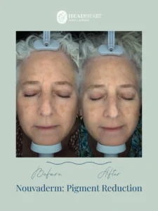Before and after comparison of facial pigment reduction treatment on an elderly woman.