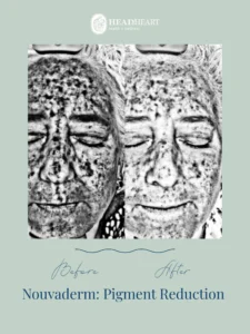 Before and after black and white facial images showing pigment reduction treatment results.