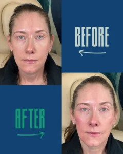 Before and after close-up portraits of a woman with light skin, showing facial skin changes.