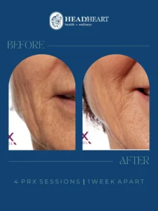 Before and after close-up images of facial skin showing wrinkle reduction, with text "4 PRX sessions 1 week apart.