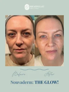 Before and after close-up photos of a woman's face showing improved skin tone and reduced dark circles.