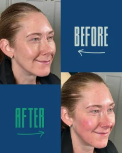 Before and after close-up images of a woman's face showing skin redness increase post-treatment.