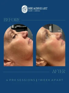 Before and after side profile images of a woman's face showing improved skin texture and reduced wrinkles.