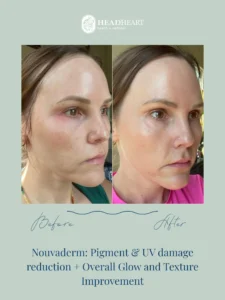 Before and after side profile images of a woman showing reduced pigmentation and improved skin texture and glow.
