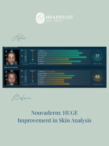 Skin analysis comparison charts showing before and after photos with improved scores and reduced skin issues.